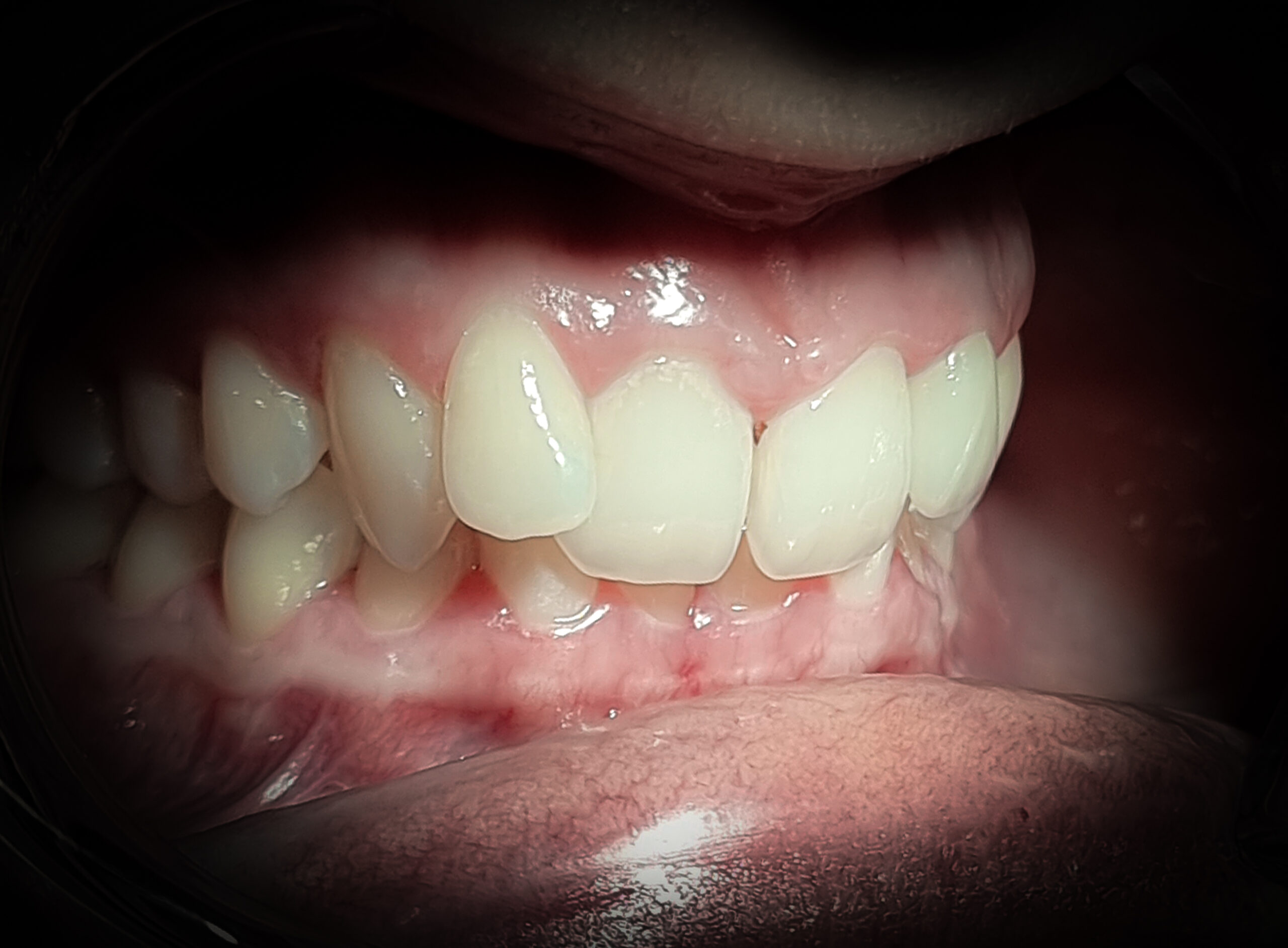 torlodas_overjet_overbite-2